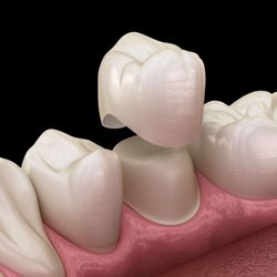 Progressive Dental - Crown placement