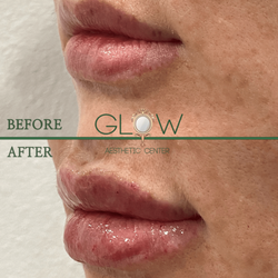 Glow Aesthetic Center - Lip Filler Before & After. Thousand Oaks Med Spa Glow Aesthetic Center. Juvederm and Restylane Fillers.