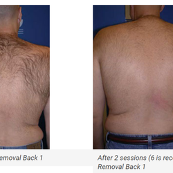 Body Beautiful Laser Medi-Spa - Hair Removal Bridgewater, PA