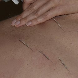 Jarmila Acupuncture