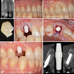 CeraRoot Zirconia Implants - Holistic Dentistry - Nice sequence to see all the steps.