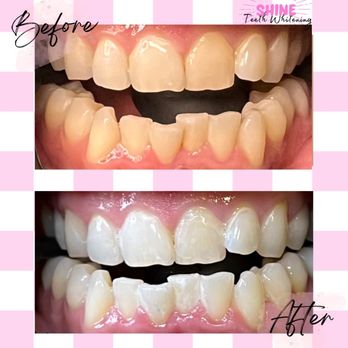 Shine Teeth Whitening - Before and after regular whitening session - Teeth Whitening Near Me Shine Teeth Whitening - Before and after regular whitening session - Teeth Whitening Near Me