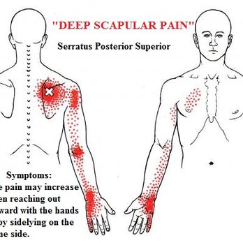 Trigger Point Massage OC - "Deep scapular pain" - Massage Therapy Near Me - Laguna Niguel, California Trigger Point Massage OC - "Deep scapular pain" - Massage Therapy Near Me - Laguna Niguel, California