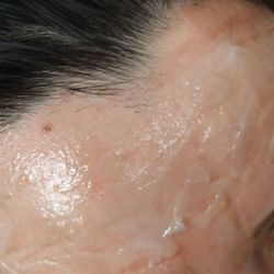 Bodysculpture NOVA - The laser burned my hairline.