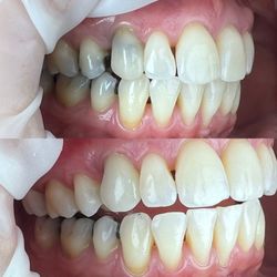 Hi'iaka Dental Studio - Before and after of upper right transformation