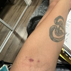 Behnoush Zarrini, MD - Bruises