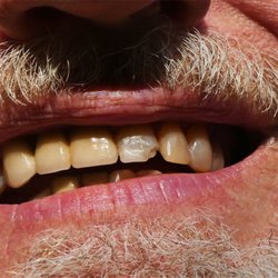 Eberhardt August A Dentist - He sliced my tooth. Shaky hands.