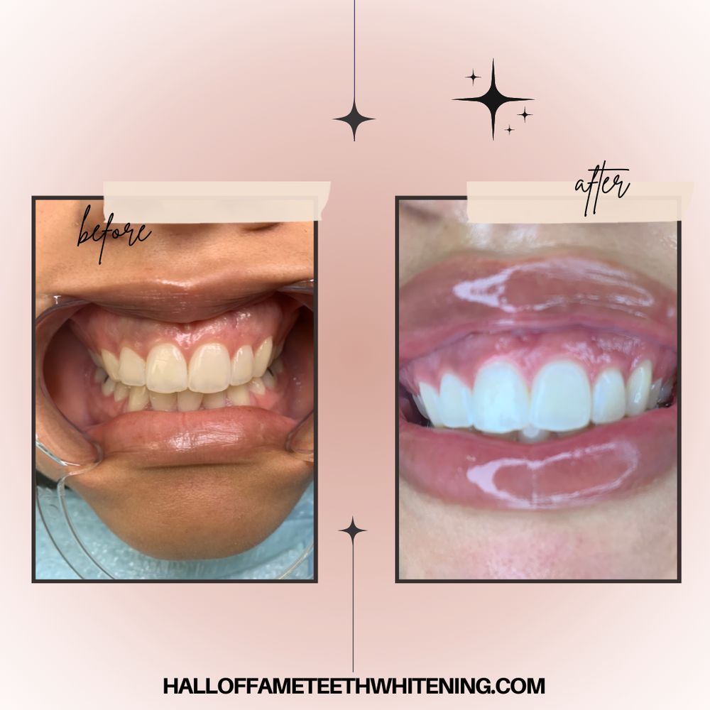 Halll Of Fame Teeth Whitening Logo