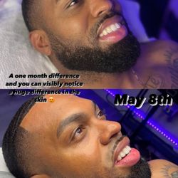 An amazing ONE MONTH difference in our client's skin after receiving only 2 facials and sticking to his recommended home care routine!