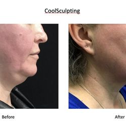 Butterfly Medical Spa - Coolsculpting for under chin treatment