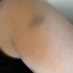 Glenwood Surgery Center - Bruise day one