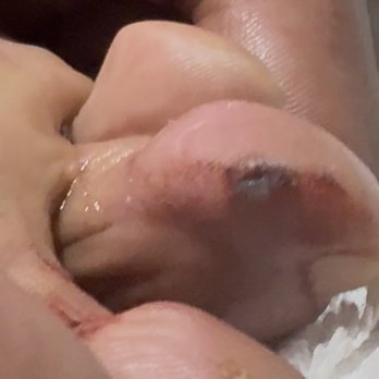 Nail Art Spa - the skin was removed from two toes - Nail Salons Near Me - Hackensack, New Jersey