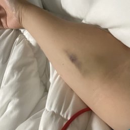 Bruising 3 weeks after my blood work. Lasted for 2 months, along with sensitivity and pain. Bruising 3 weeks after my blood work. Lasted for 2 months, along with sensitivity and pain.