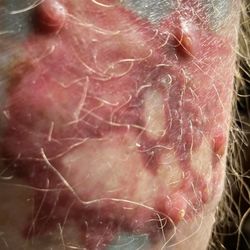 Ann Arbor Laser Tattoo Removal Specialists - After 10 weeks.