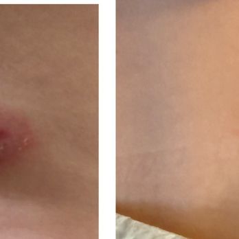 South Hill KinderCare - I was notified my daughter had been bitten on her arm, but no one was even aware of this bite on her back - if it's even a bite. - Child Care & Day Care Near Me - Spokane, Washington South Hill KinderCare - I was notified my daughter had been bitten on her arm, but no one was even aware of this bite on her back - if it's even a bite. - Child Care & Day Care Near Me - Spokane, Washington