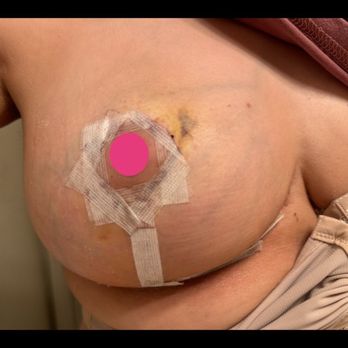 Elliot M Hirsch, MD - En bloc with a Lift (3Wks Po) - Cosmetic Surgeons Near Me - Sherman Oaks, California