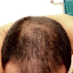 Bosley Hair Restoration & Transplant - My before picture before the surgery