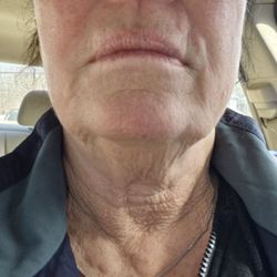 My before and after