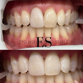 Enlightened Smile - Teeth Whitening Near Me - Lawndale, California Enlightened Smile - Teeth Whitening Near Me - Lawndale, California