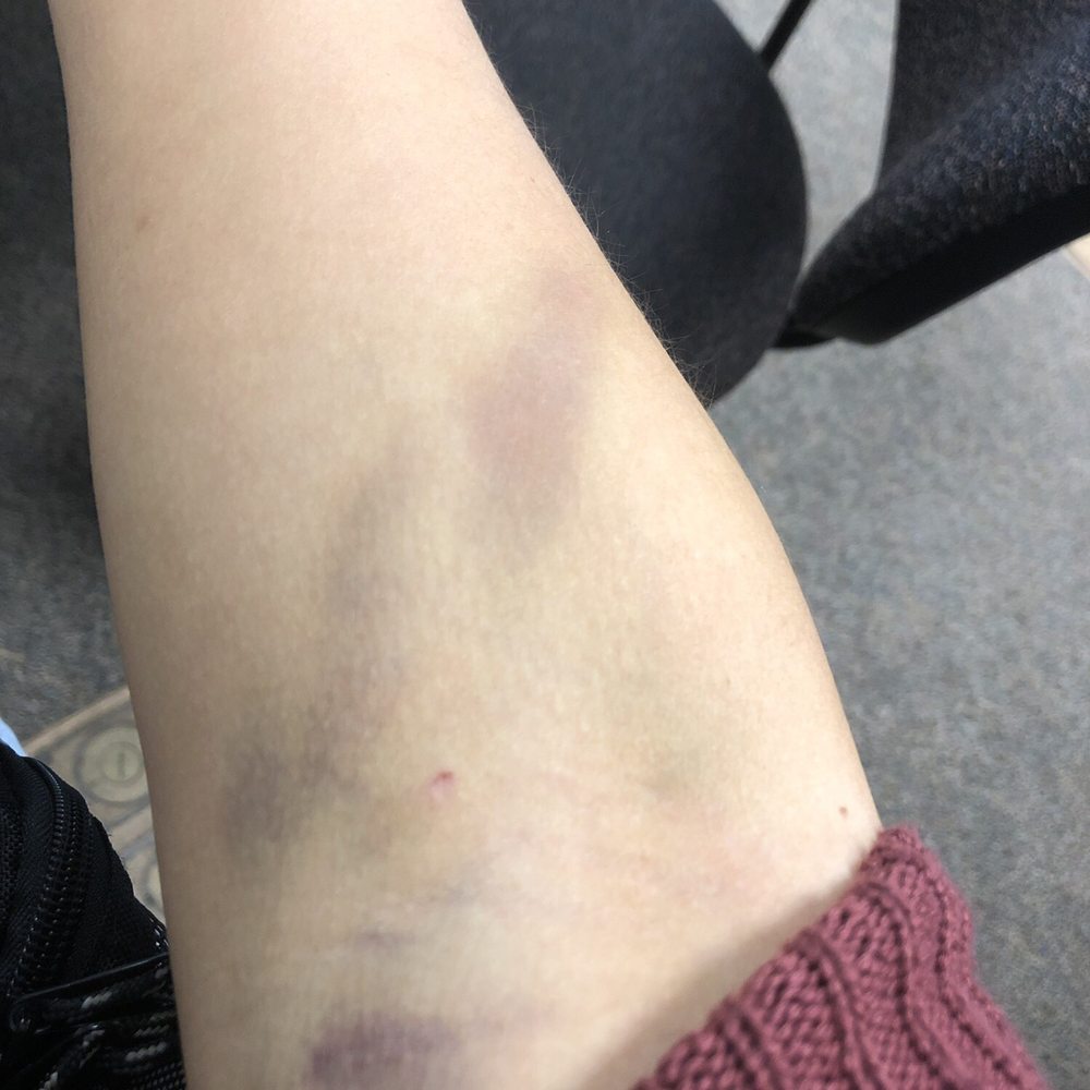 BioLife Plasma Services - First time donating in a month because I couldn't before since they lost my blood sample couple of times. They ended up breaking my vein. - Blood & Plasma Donation Centers Near Me - Eau Claire, Wisconsin