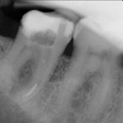 Open Door Family Dentistry - 2 broken files in a tooth on a root canal.