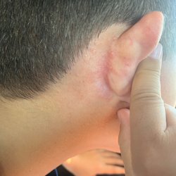 Unclean razor = folliculitis. Thanks great and dirty clips. Hair cut just cost us an extra $75.00