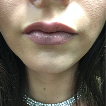 Botox by Dr Landsman - Smithtown - Medical Spas Near Me - Smithtown, New York Botox by Dr Landsman - Smithtown - Medical Spas Near Me - Smithtown, New York