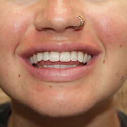 Grit & Glam Beauty Lounge - Results of initial teeth whitening treatment.