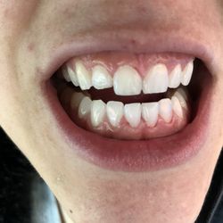 Phi Phuoc Dental Clinic - Gums bleeding and swollen, hurting too.