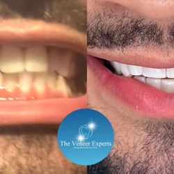 The Veneer Experts - Veneers before and after