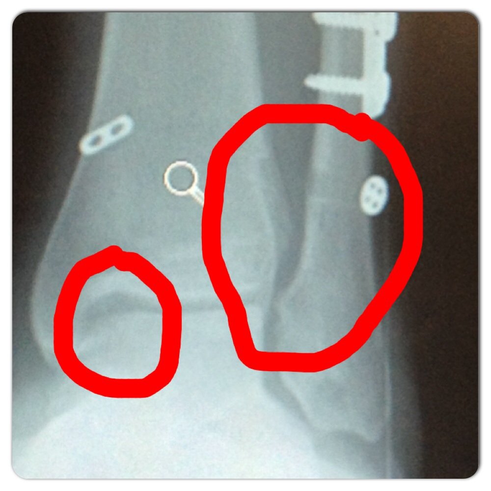 Jeffrey A. Mann, M.D - These gaps should not be there that's where some of the pain is - Orthopedists Near Me - Oakland, California