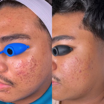 Luxe & Nova - Acne Clear Skin Program - 5 month progress - Skin Care Near Me - Waipahu, Hawaii Luxe & Nova - Acne Clear Skin Program - 5 month progress - Skin Care Near Me - Waipahu, Hawaii