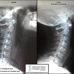 Advanced Spine & Health Center of Cache Valley - Results you can see! Look at this patients progress.