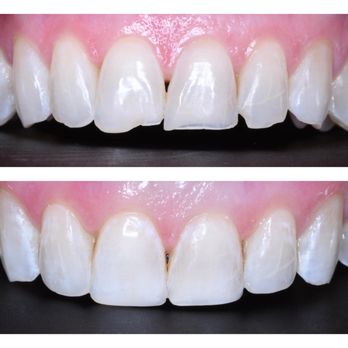 Studio Dental - Conservative Cosmetic Composites allow us to modify the shape and edges of front teeth without needing Veneers. - General Dentistry Near Me - San Francisco, California Studio Dental - Conservative Cosmetic Composites allow us to modify the shape and edges of front teeth without needing Veneers. - General Dentistry Near Me - San Francisco, California
