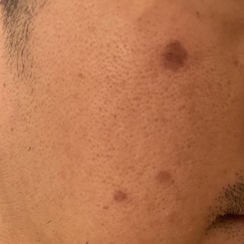 Exceptional Dermatology Care - Before picture of dark spots - Dermatologists Near Me - Fullerton, California Exceptional Dermatology Care - Before picture of dark spots - Dermatologists Near Me - Fullerton, California
