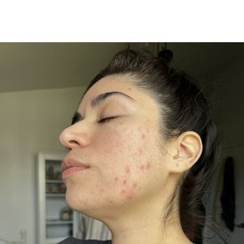 Daisy MD Care - Throughout the process - Acne Treatment Near Me - Santa Ana, California Daisy MD Care - Throughout the process - Acne Treatment Near Me - Santa Ana, California