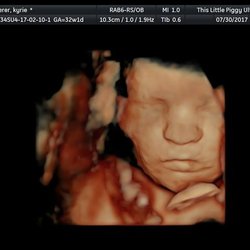 This Little Piggy Ultrasound - HD Live