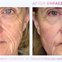 Fort Myers DPC & Wellness - Emface is a non invasive nonsurgical procedure to help lift your face muscles, this procedure helps with jowls, skin laxity and facial aging