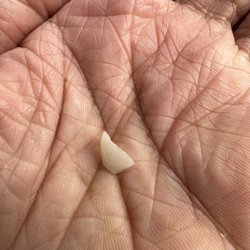 Hayward Dental Arts - My broken crown teeth .