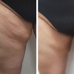 Anti Aging Center of Boca - My right leg.. she photoshopped the after pic. I saw it in her phone when she took it and it didn't look like that.