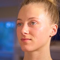 White Lotus Healing Spa - From fragile to flawless, she was struggling with acne, redness and sensitivity.  COMBO of facials, peels and homecare corrected her skin.