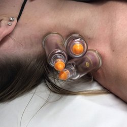Central Coast Red Coral Spa - Body cupping. For pain relief, and helping to lift and move stagnation within the body so the body can heal and function better!