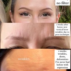 One Agora Integrative Health Clinic - Top: botox done beautifully by Ashly who moved to FL... Bottom 2: botox done poorly by Chelsea, I have to find a different clinic to fix it