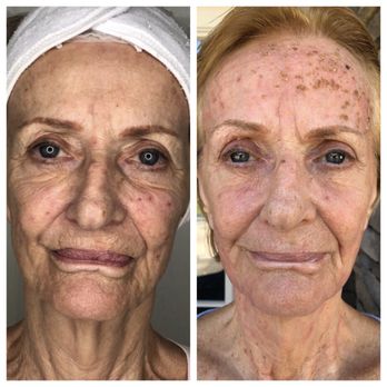 Yamila's Faces Skin Care - Fibroplasty full face - Skin Care Near Me - Hallandale Beach, Florida Yamila's Faces Skin Care - Fibroplasty full face - Skin Care Near Me - Hallandale Beach, Florida