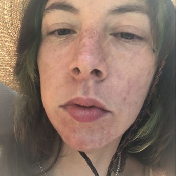 Artemedica - 2 weeks post treatment in the sun didn't know! - Medical Spas Near Me - Santa Rosa, California Artemedica - 2 weeks post treatment in the sun didn't know! - Medical Spas Near Me - Santa Rosa, California
