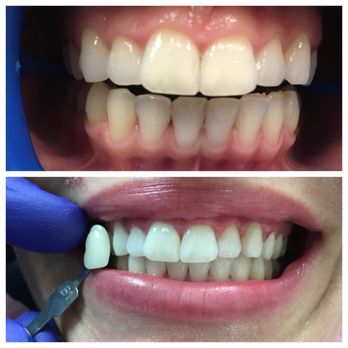 Dr Deepa Suryanarayanan - Zoom Whitening - General Dentistry Near Me - Hyattsville, Maryland Dr Deepa Suryanarayanan - Zoom Whitening - General Dentistry Near Me - Hyattsville, Maryland