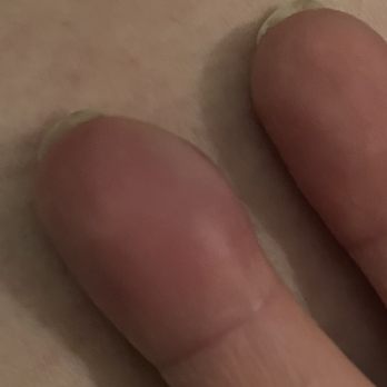 Chic Nails & Spa - Infected finger - Nail Salons Near Me - Blue Springs, Missouri