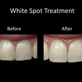 Musselman Dentistry - White spot treatment - General Dentistry Near Me - Phoenix, Arizona