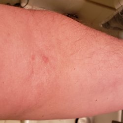 CSL Plasma - Barely a mark at all.