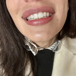 Historic Core Dental Care - Fixed up front right tooth